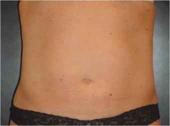 SmartLipo MPX after 686076