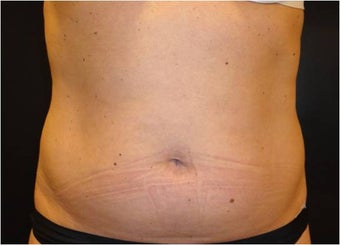 SmartLipo MPX before 686076