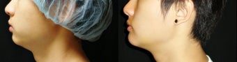 Chin Augmentation (Chin Implant) before 937699