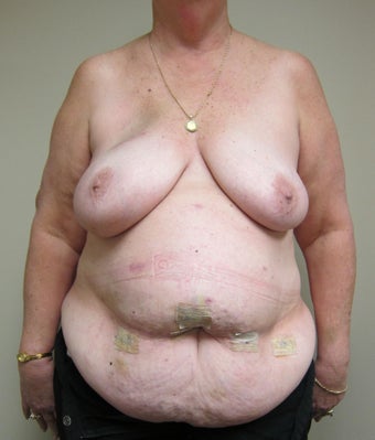 61-year-old female with bilateral immediate DIEP flap breast reconstruction before 698999