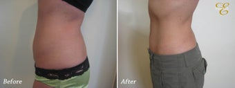 Smart Lipo before 342285