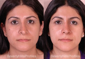 Revision Rhinoplasty before 681871