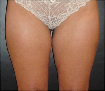 SmartLipo MPX after 686370