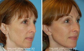Facelift before 91473