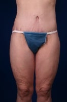 42 Year Old Femal With Medial Thigh Laxity After Weight Loss after 777517