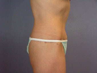 Tummy Tuck after 280114