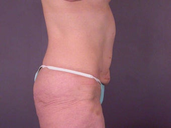 Tummy Tuck before 280114
