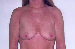 Breast Implants before 1072763