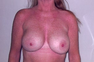Breast Implants after 1072763