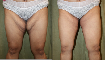 Thigh lift before 1237830