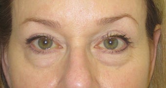 Lower lid fat prolapse, right worse than left. Loss of midface volume. before 1032176