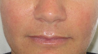 39 year old undergoing fillers to her nasolabial folds after 811436