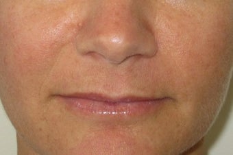 39 year old undergoing fillers to her nasolabial folds before 811436