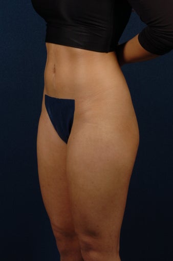 20 Year Old Female - Gluteal Augmentation 362445