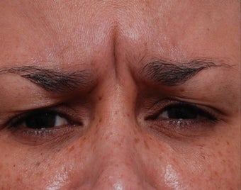 Female Treated for Forehead Wrinkles before 772010