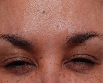 Female Treated for Forehead Wrinkles after 772010