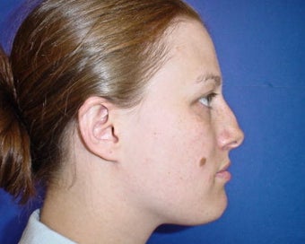 Septorhinoplasty 644820