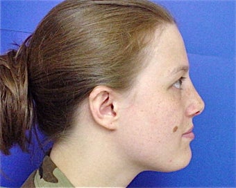 Septorhinoplasty 644820