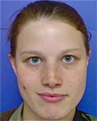 Septorhinoplasty after 644820