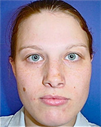 Septorhinoplasty before 644820