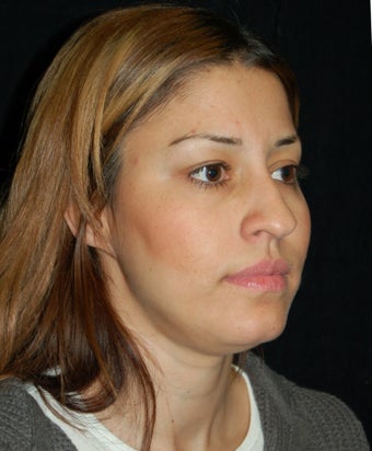 Cheek Fat Pad Removal before 902792