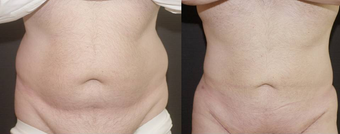 Liposculpture before 657921