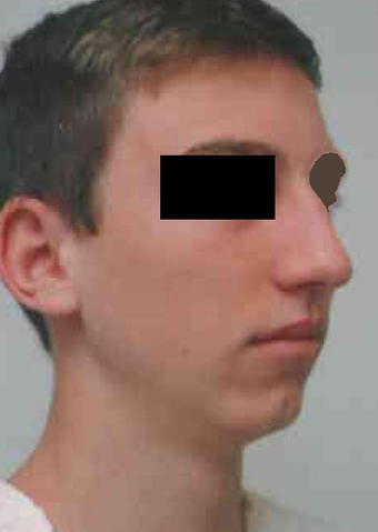 Chin Implant before 724317