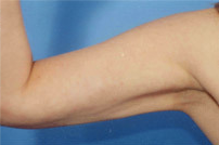 Arm Liposuction after 652128