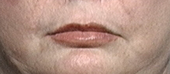 Lip Augmentation after 639522