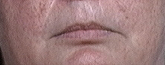 Lip Augmentation before 639522
