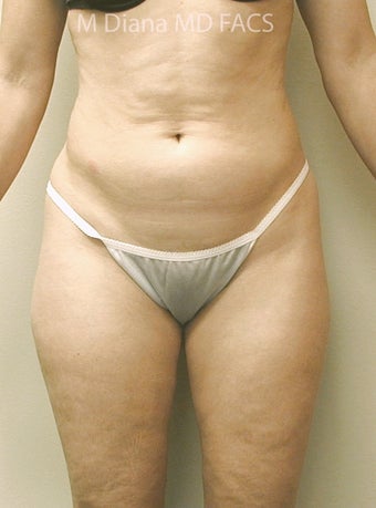 SmartLipo before 607527
