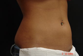 Coolsculpting after 391290