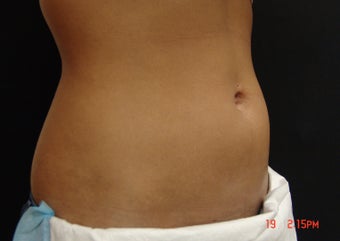 Coolsculpting before 391290