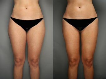 SmartLipo Liposuction of Thighs before 277370