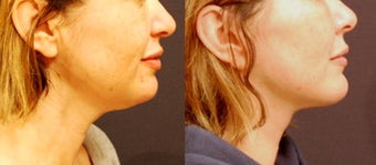 Mini Facelift before 489297