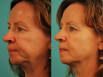 Cheek Filler after 1195709