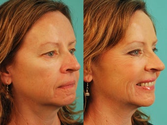 Cheek Filler before 1195709