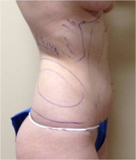 Laser Liposuction 561154