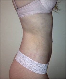 Laser Liposuction 561154