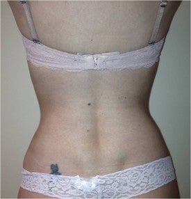 Laser Liposuction after 561154