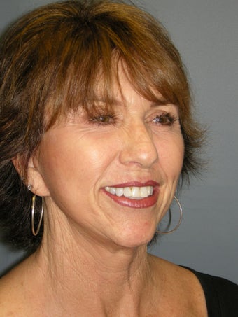 Blue Peel, Chemical Peel 954429