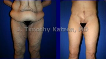Leg Lift after weight loss surgery before 660703