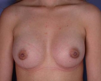 Breast Augmentation after 281383