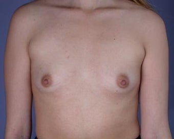 Breast Augmentation before 281383
