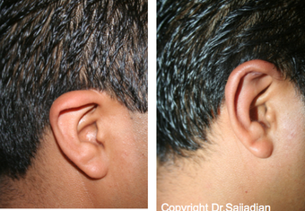 Ear Surgery before 1245315
