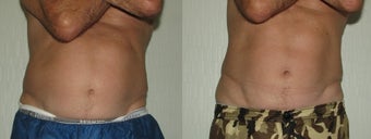 Male Patient Immediately after 4th Vanquish Treatment before 1114186