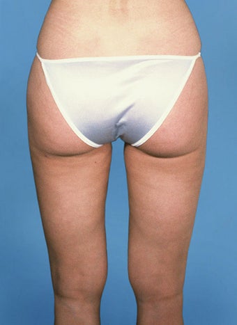 Liposculpture after 109224