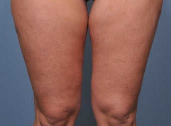 35 Year Old Female Treated For Abdominal and Thigh Skin Excess after 920529