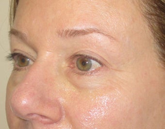 46 year old with eyelid bags undergoing filler treatment before 811417
