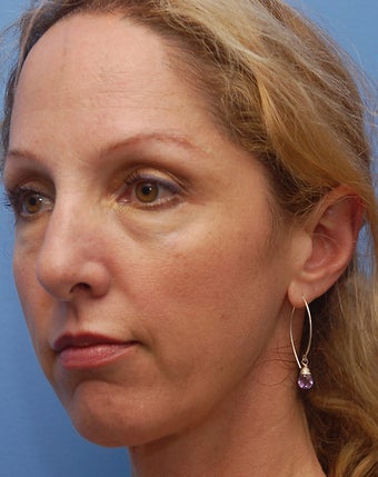 Cheek Dermafillers, Eye Dermafillers, Facial Dermafillers before 238421